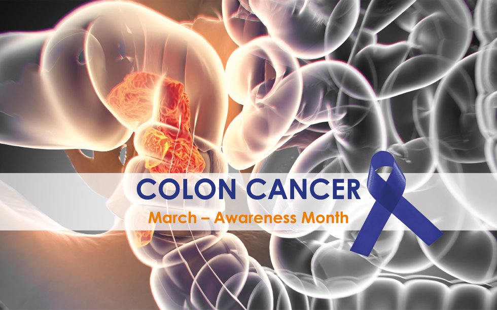 Colon Cancer prevention